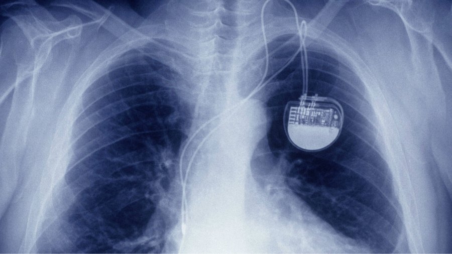 Le plus petit pacemaker sans fil au monde implanté chez nous 
