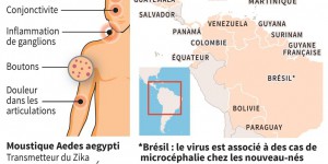 Zika, la menace des femmes enceintes 