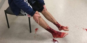 Un Australien attaqué jusqu’au sang par des puces marines