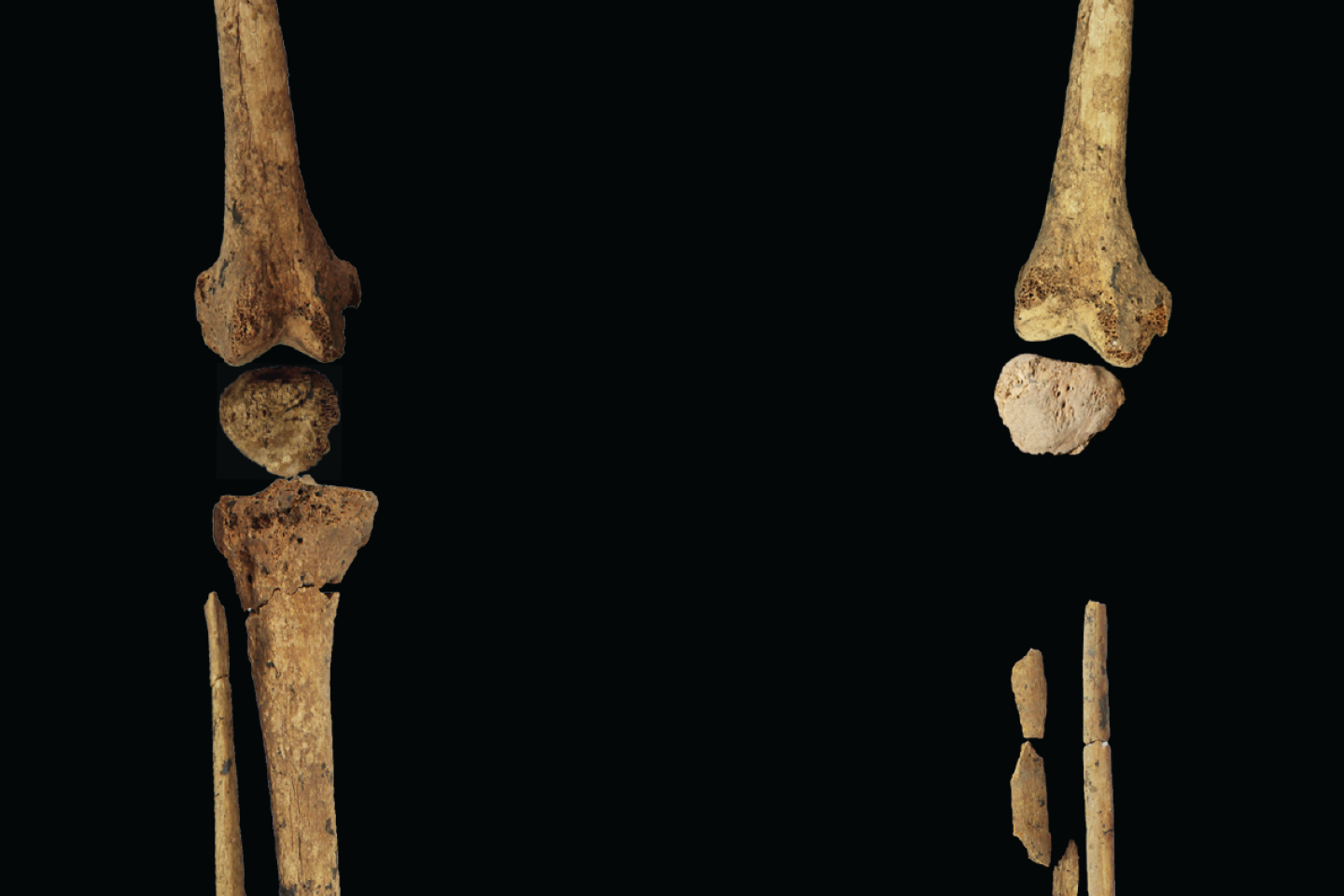 A Bornéo, une amputation sur un jeune chasseur-cueilleur réalisée il y a 31 000 ans