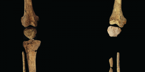 A Bornéo, une amputation sur un jeune chasseur-cueilleur réalisée il y a 31 000 ans