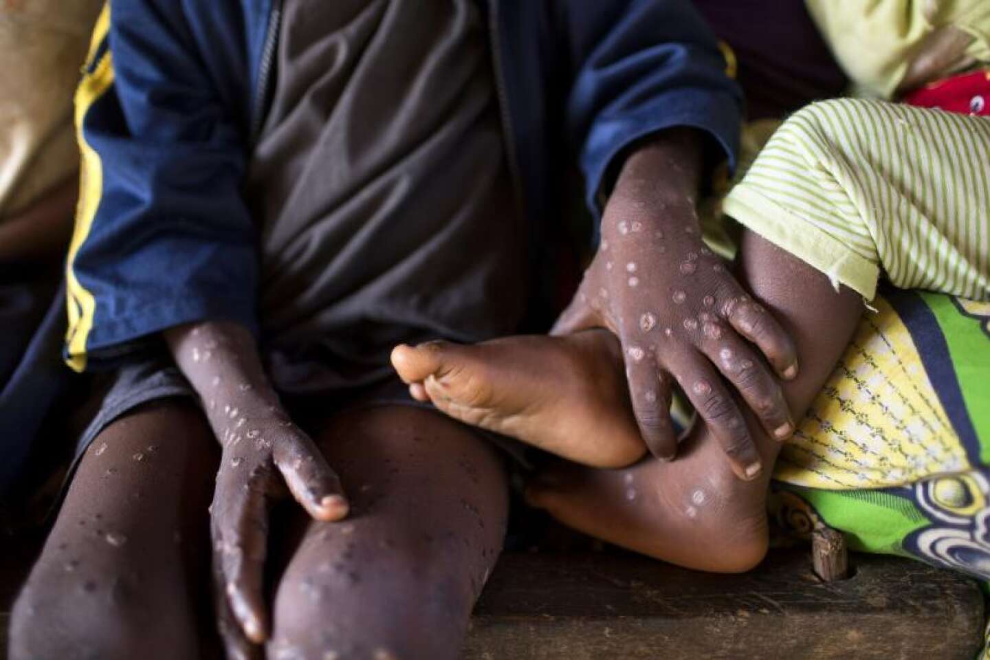 Epidémie de mpox en RDC : 581 décès depuis janvier et nombre de cas record sur une année