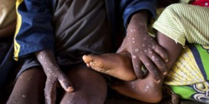 Epidémie de mpox en RDC : 581 décès depuis janvier et nombre de cas record sur une année