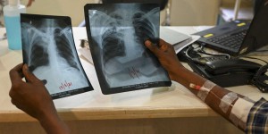 Tuberculose : les millions de cas non diagnostiqués compromettent les efforts de lutte